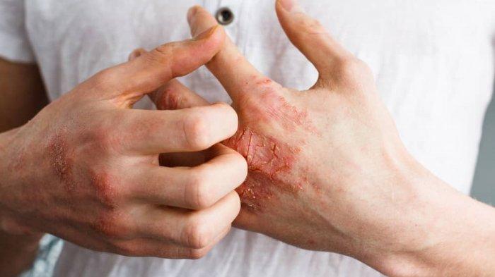 Salah satu penyakit akibat autoimun yang menyerang kulit (Foto:Hello Sehat.com)