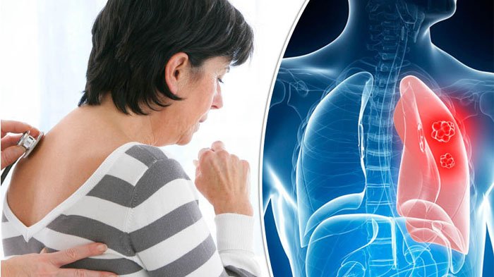 Jaga kesehatan paru untuk mencegah penyakit kanker paru (Foto :Express.co.uk)