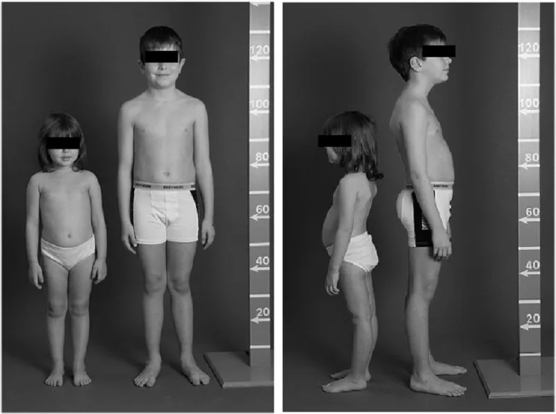 Perbedaan tubuh akibat sindrom fanconi bicker (Foto:sciencedirect.com)