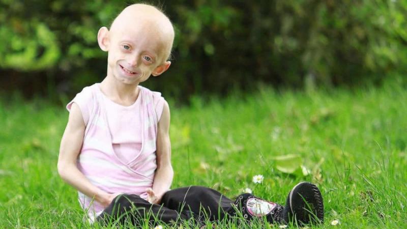 Salah satu penyakit aneh dan langka Progeria (Foto:Healthjade.com)
