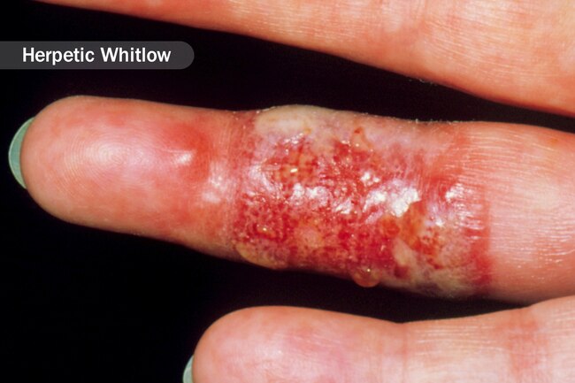 Salah satu akibat penyakit Herpetic Whitlow (Foto:Webmd.com)