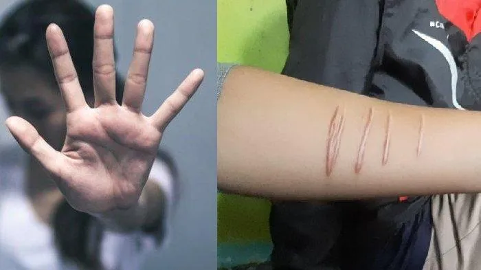 Bekas luka sayatan di tangan Ika Musraiti (Tribunnews)