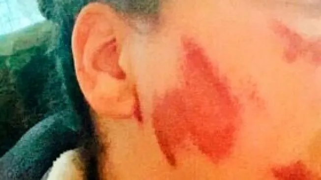 Seorang mahasiswi kulit hitam Amerika Serikat, Althea Bernstein, menjadi korban kejahatan rasial saat berkendara di Madison, Wisconsin, Rabu (24/6/2020). (Dok. Althea Bernstein/AP)