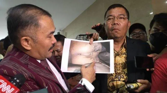 Kuasa hukum Brigadir J beberkan bukti bekas jeratan di tubuh korban (Dok.Kompas)
