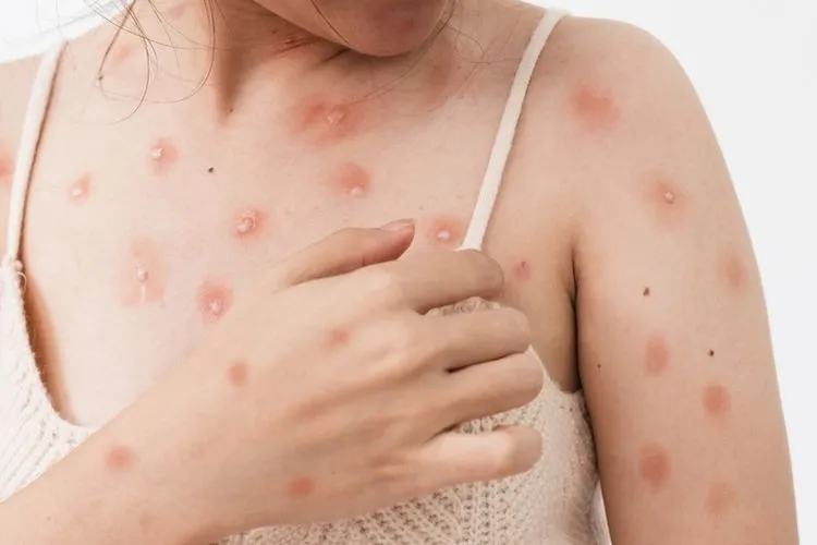 WHO Tetapkan Mpox  Sebagai Darurat Kesehatan Global.  foto:grid.id