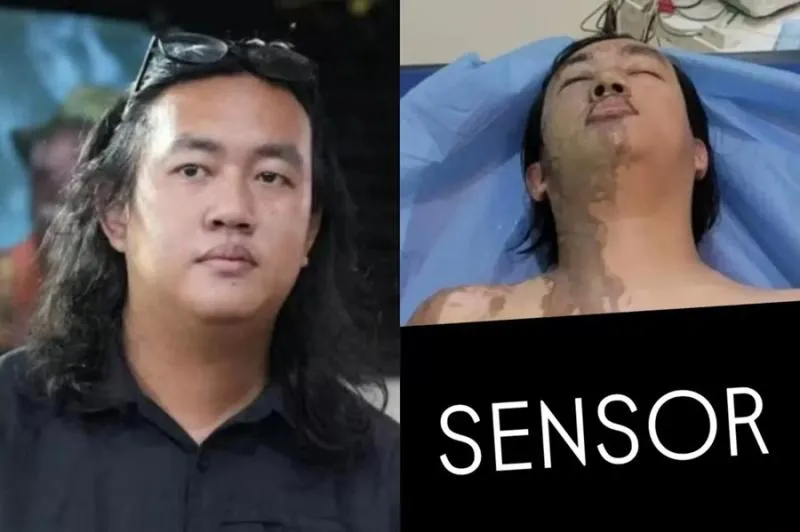 Usai Disiram Air Keras, Kornea Mata Aktivis KontraS Andrie Yunus Rusak. (Istimewa).