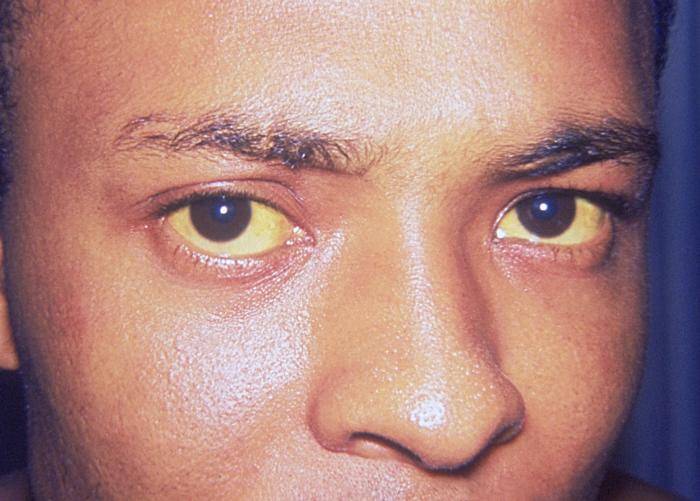 Mata kuning akibat hepatitis (foto: yalemedicalgroup)